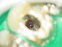 マイクロスコープを使った歯の根の治療