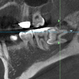 親知らずの抜歯