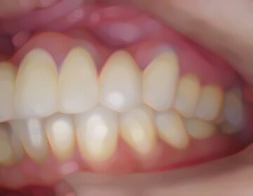 噛み合わせの治療