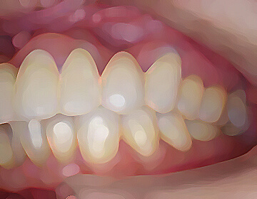 噛み合わせの変更