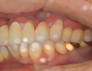 噛み合わせの変更