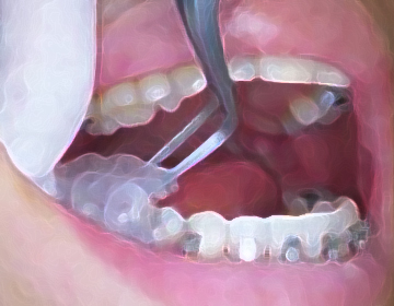 ブラケット装着