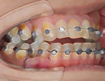 ワイヤーベント