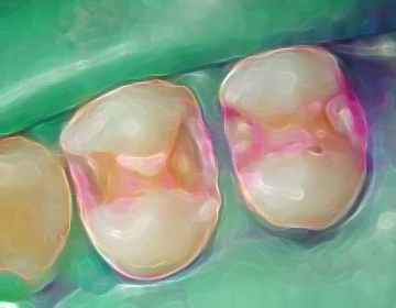 虫歯を染め出し