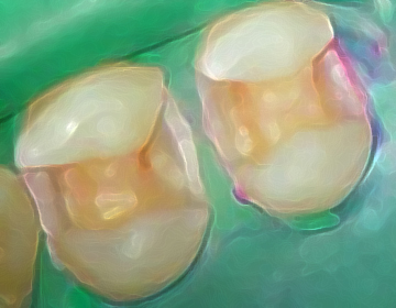 虫歯を完全に除去