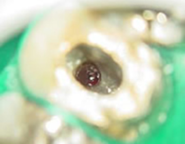 歯の周りは残す