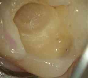 スリーウェイシリンジ